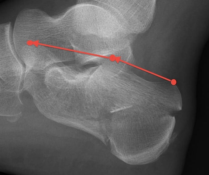 Calcaneal Fracture Reduced Bohlers Angle